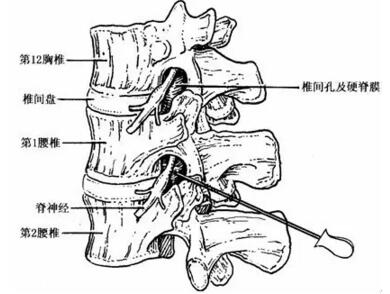 三,腰椎管狭窄症的症状